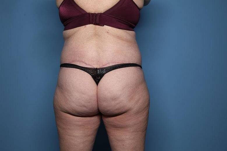 Rear View After thumbnail