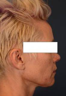 Before thumbnail