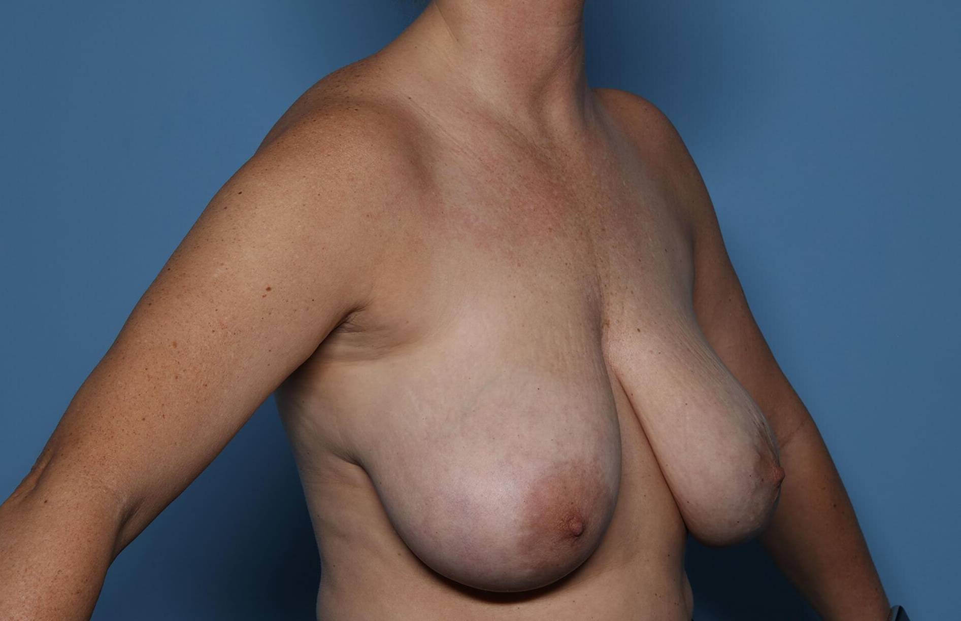 3/4 Right View Before thumbnail