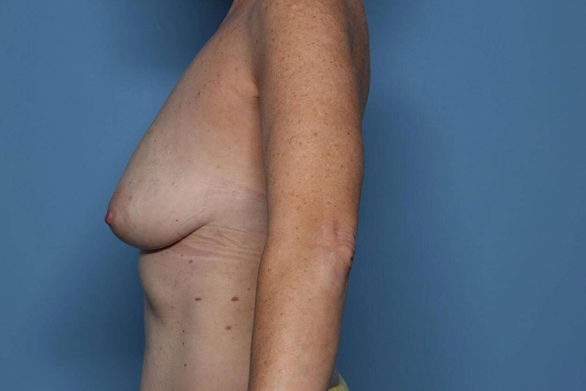 Left View Before thumbnail