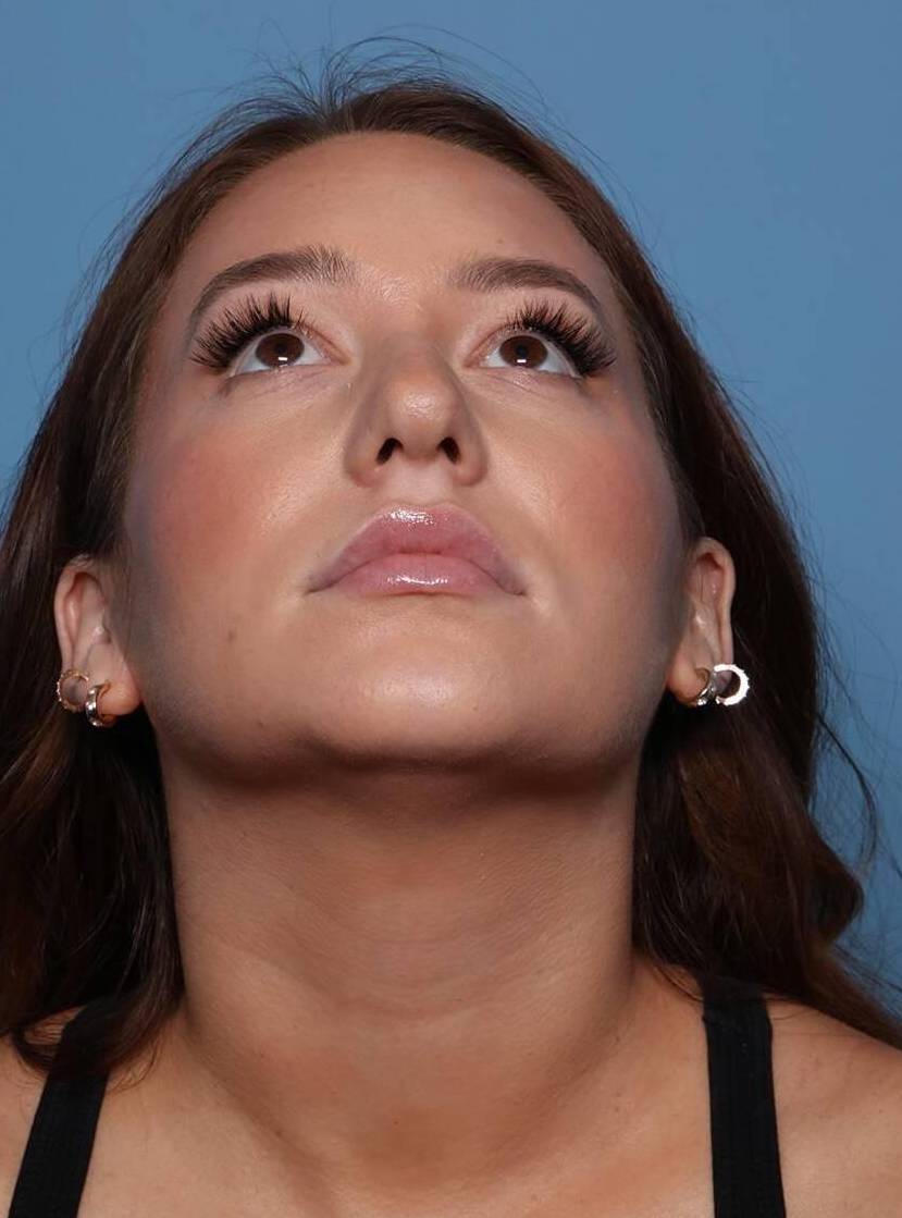 Chin View Before thumbnail