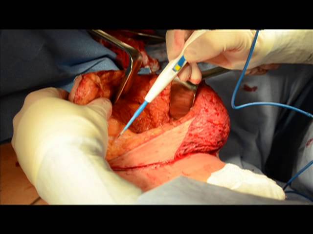 Oncoplastic Breast Reduction-Reconstruction at West County Plastic Surgeons
