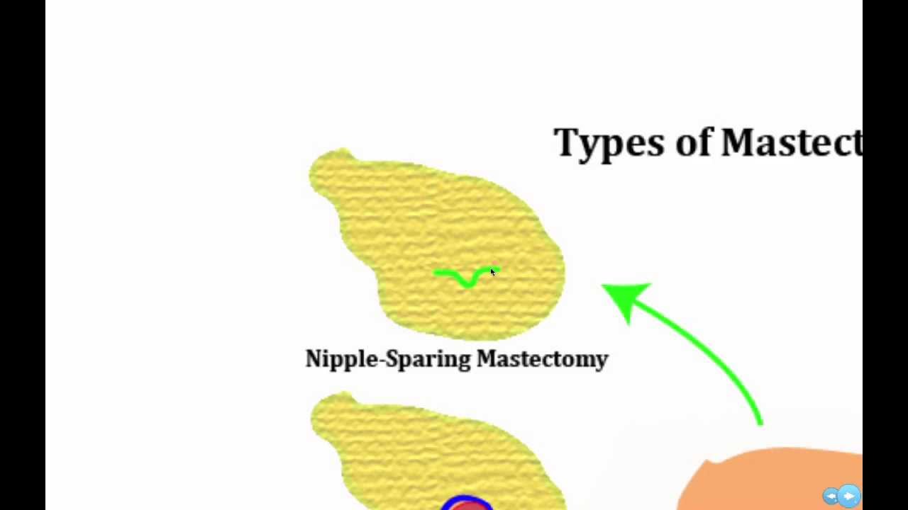 West County Plastic Surgeons Seminar: Breast Reconstruction