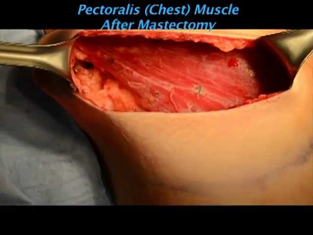Tissue Expander Breast Reconstruction at West County Plastic Surgeons