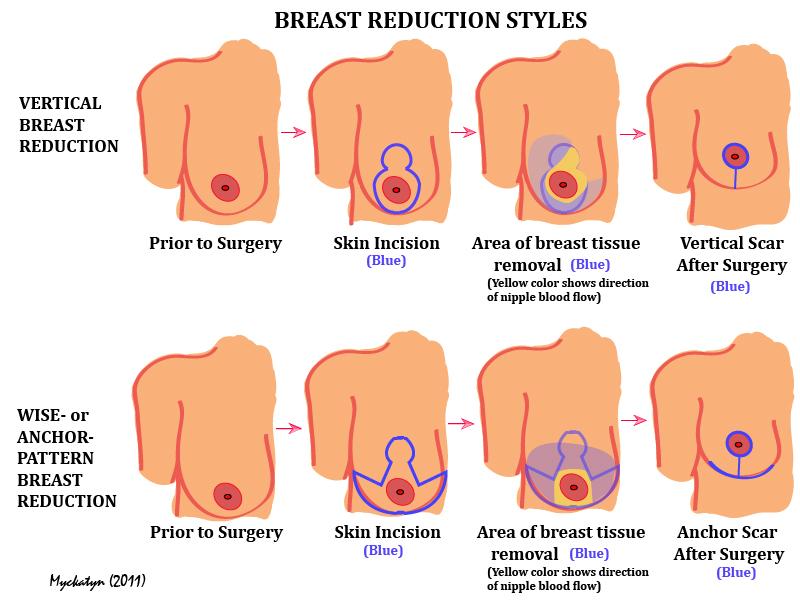 Illustration depicting breast reduction styles Illustration depicting breast reduction styles