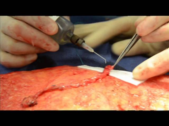 DIEP Flap Breast Reconstruction at West County Plastic Surgeons