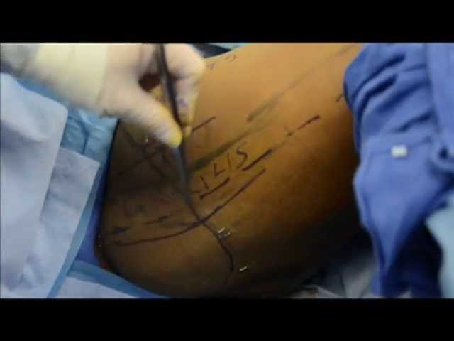 TUG Flap Method of Breast Reconstruction at West County Plastic Surgeons