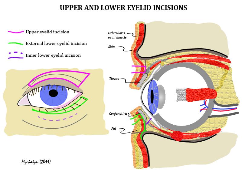 EYELID-SURGERY