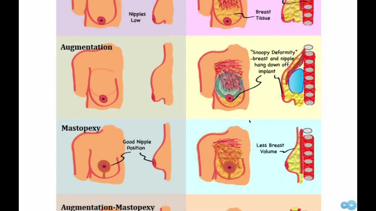 West County Plastic Surgeons Seminar: Breast Augmentation