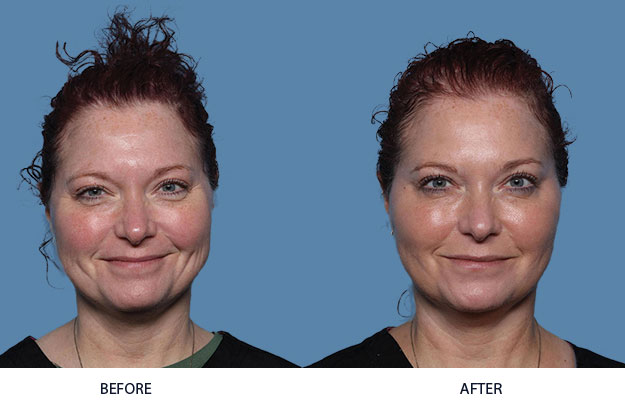 Instalift before & after