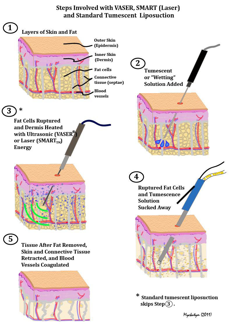 LIPO-STEPS
