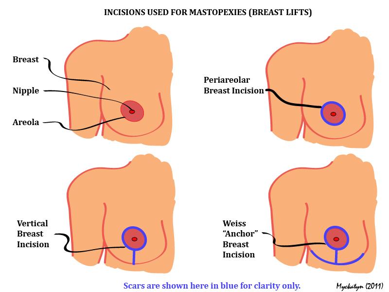 mastopexy-scars