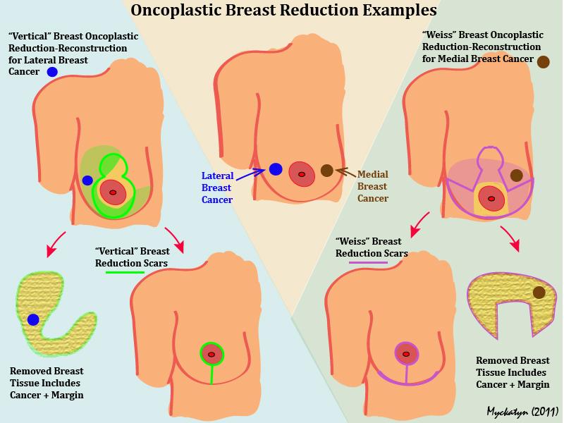 ONCOPLASTIC-BREAST-REDUCT