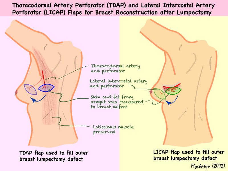 TDAP-and-LICAP