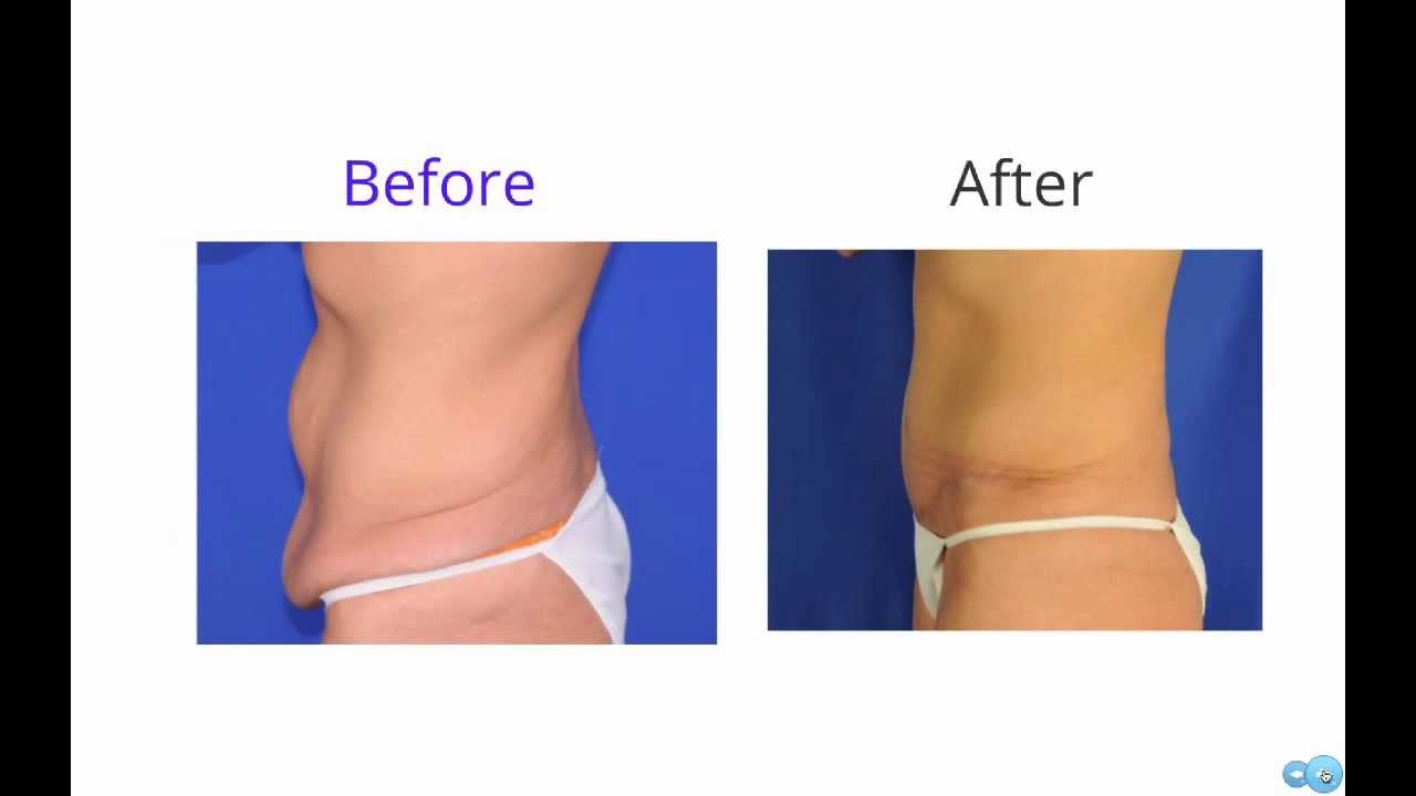 West County Plastic Surgeons Seminar: Tummy Tucks